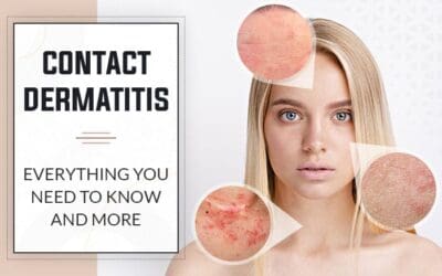 Contact Dermatitis: Everything You Need to Know and More