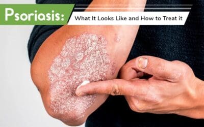 Psoriasis: What It Looks Like and How to Treat it