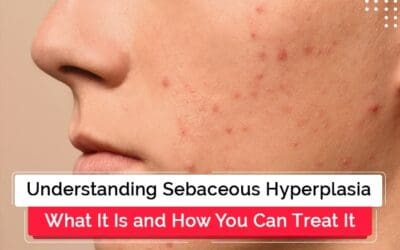 Understanding Sebaceous Hyperplasia: What It Is and How You Can Treat It