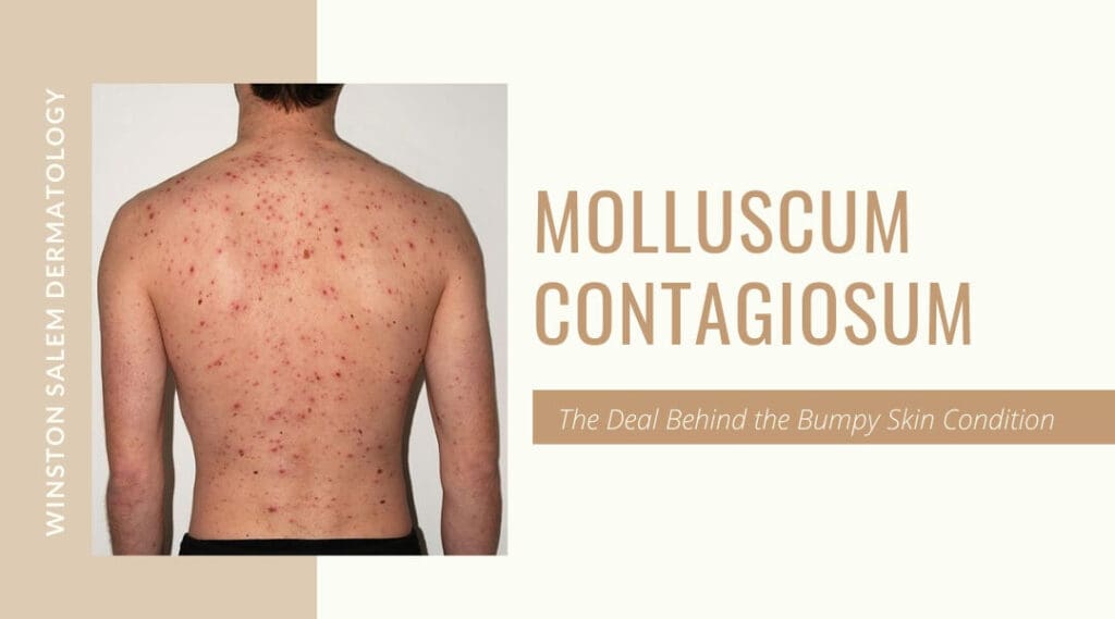 Molluscum Contagiosum Genital Area Treatment 7480