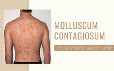 Molluscum Contagiosum – The Deal Behind the Bumpy Skin Condition