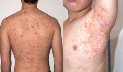 Molluscum Contagiosum – The Deal Behind the Bumpy Skin Condition ...