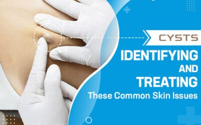 Cysts: Identifying and Treating These Common Skin Issues