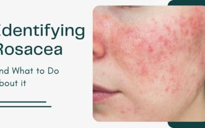 Identifying Rosacea and What to Do About it