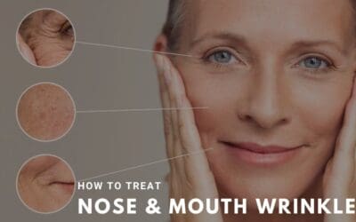 How to Treat Nose & Mouth Wrinkles