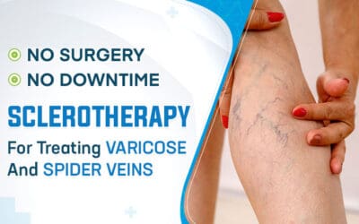 No Surgery; No Downtime: Sclerotherapy for Treating Varicose and Spider Veins