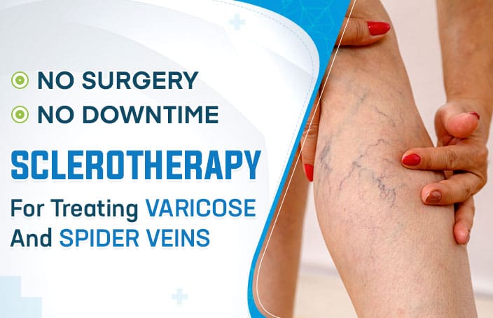 No Surgery; No Downtime: Sclerotherapy for Treating Varicose and