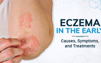 Eczema in the Early Years: Causes, Symptoms, and Treatments