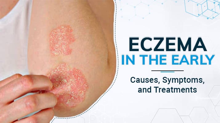 The Differences Between Rashes and Eczema (And How to Tell Which