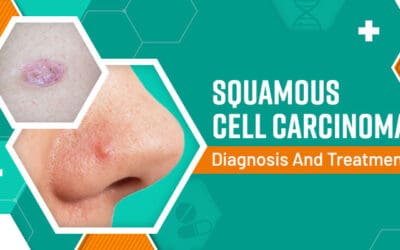 Squamous Cell Carcinoma Diagnosis and Treatment