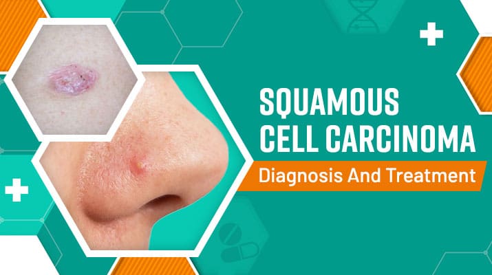 Squamous Cell Carcinoma Diagnosis and Treatment | Dermatologist
