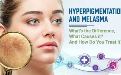Hyperpigmentation and Melasma: What’s the Difference, What Causes it? And How Do You Treat it?
