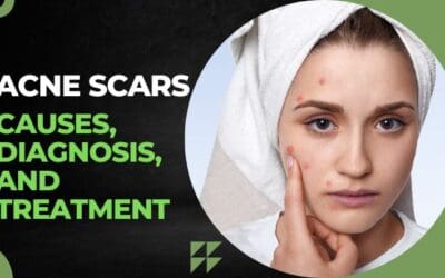 Acne Scars – Causes, Diagnosis, and Treatment